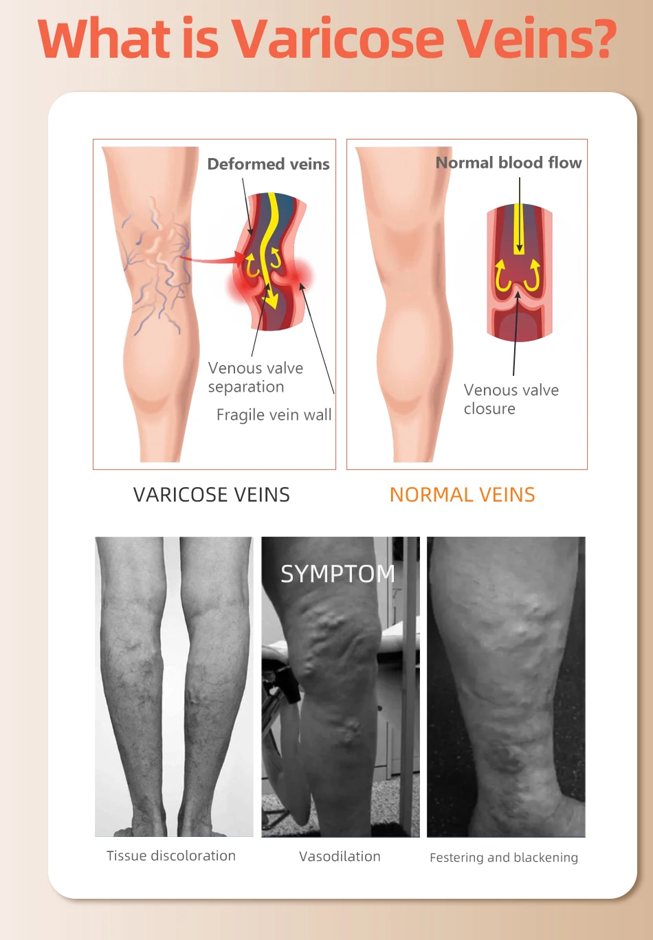 30-40 MmHg Over Knee Closed To - Echinacea ulasan dan harga